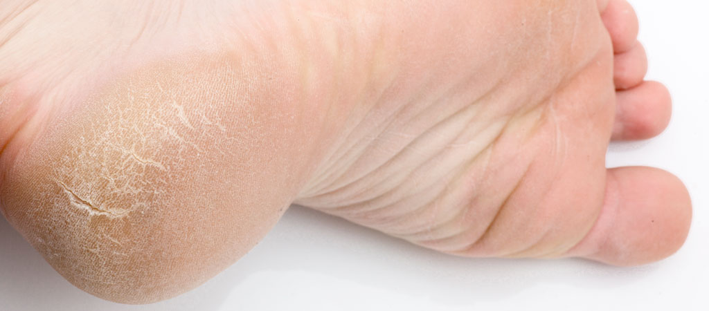 Dry Skin and Cracked Heels | Podiatry Station Edgware